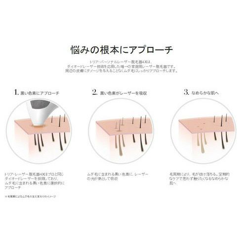 トリア(tria) 家庭用パーソナルレーザー脱毛器4X フーシャピンク 
